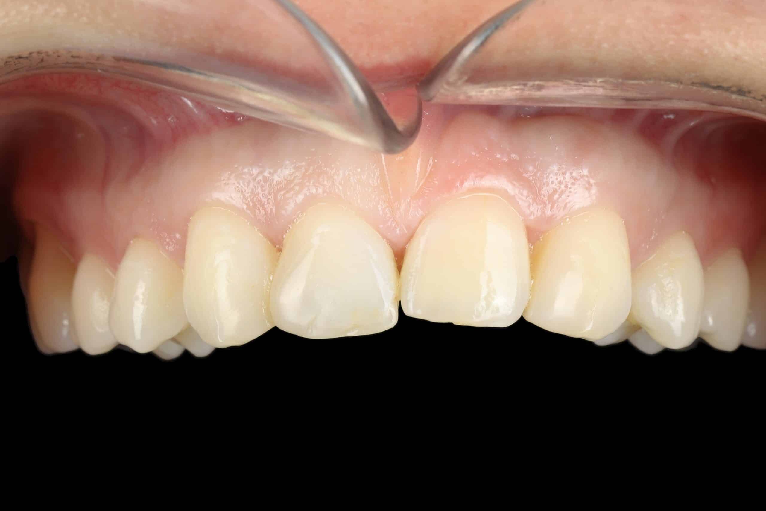 Veneers-1