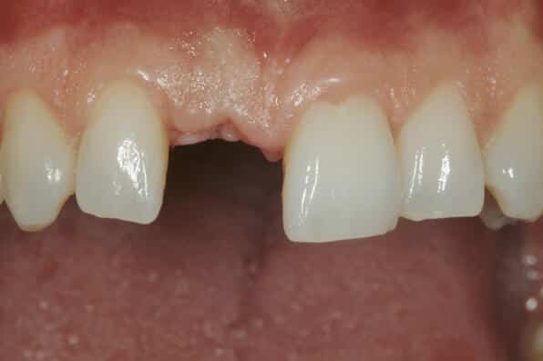 zahnarzt-luzern_implantat2