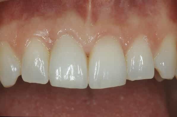 zahnarzt-luzern_implantat8