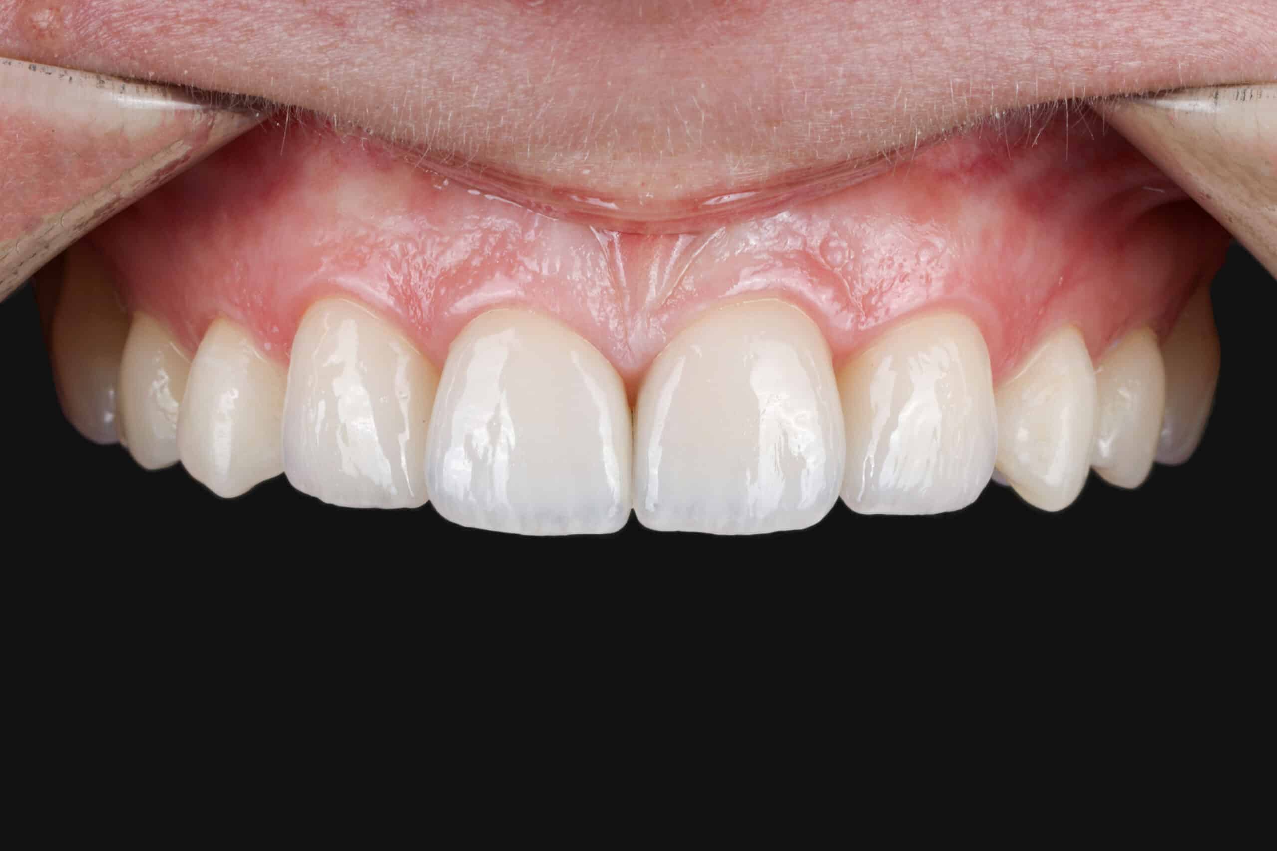 Veneers-2