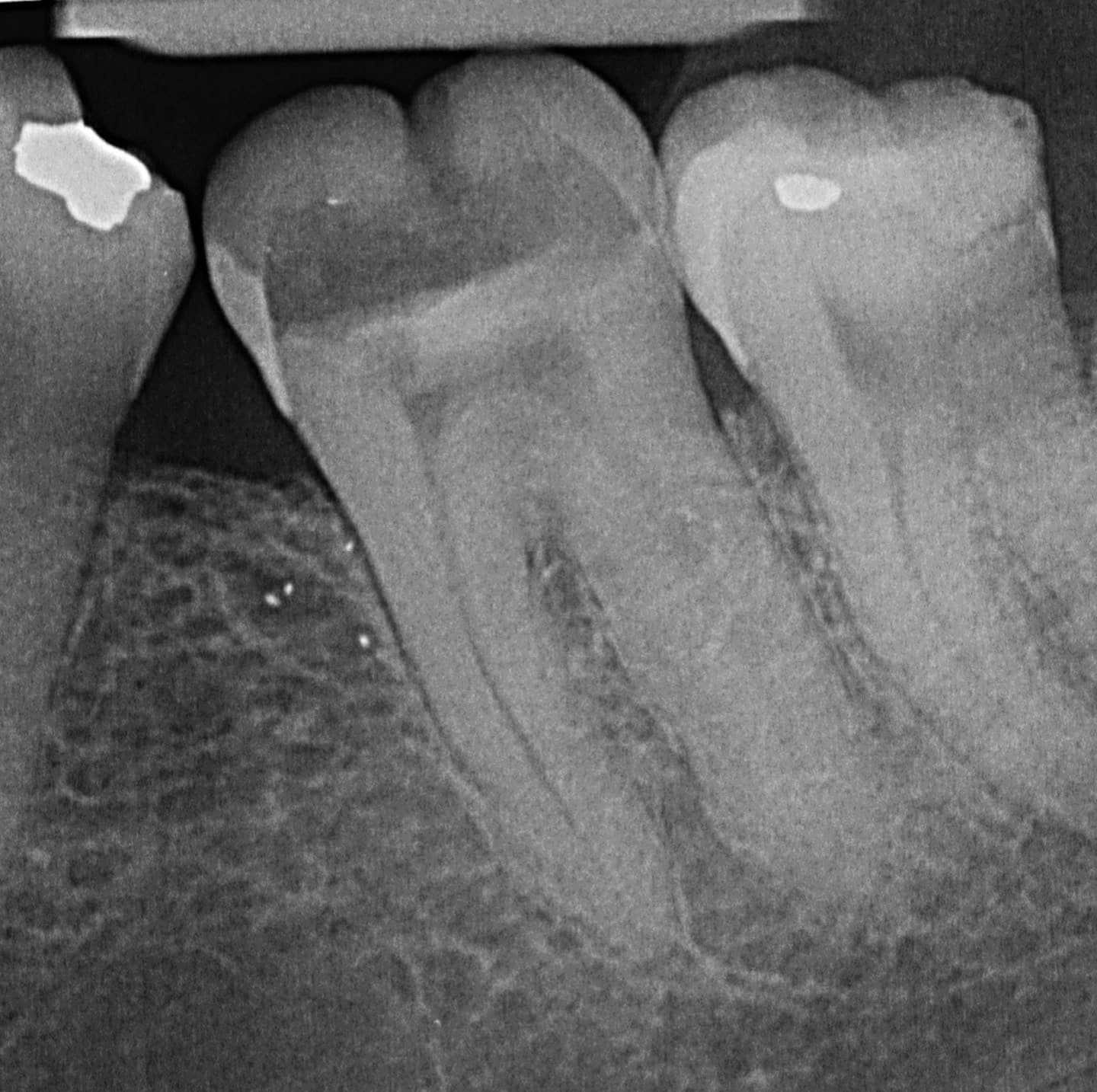 Wurzerkanalbehandlung-röntgen-2