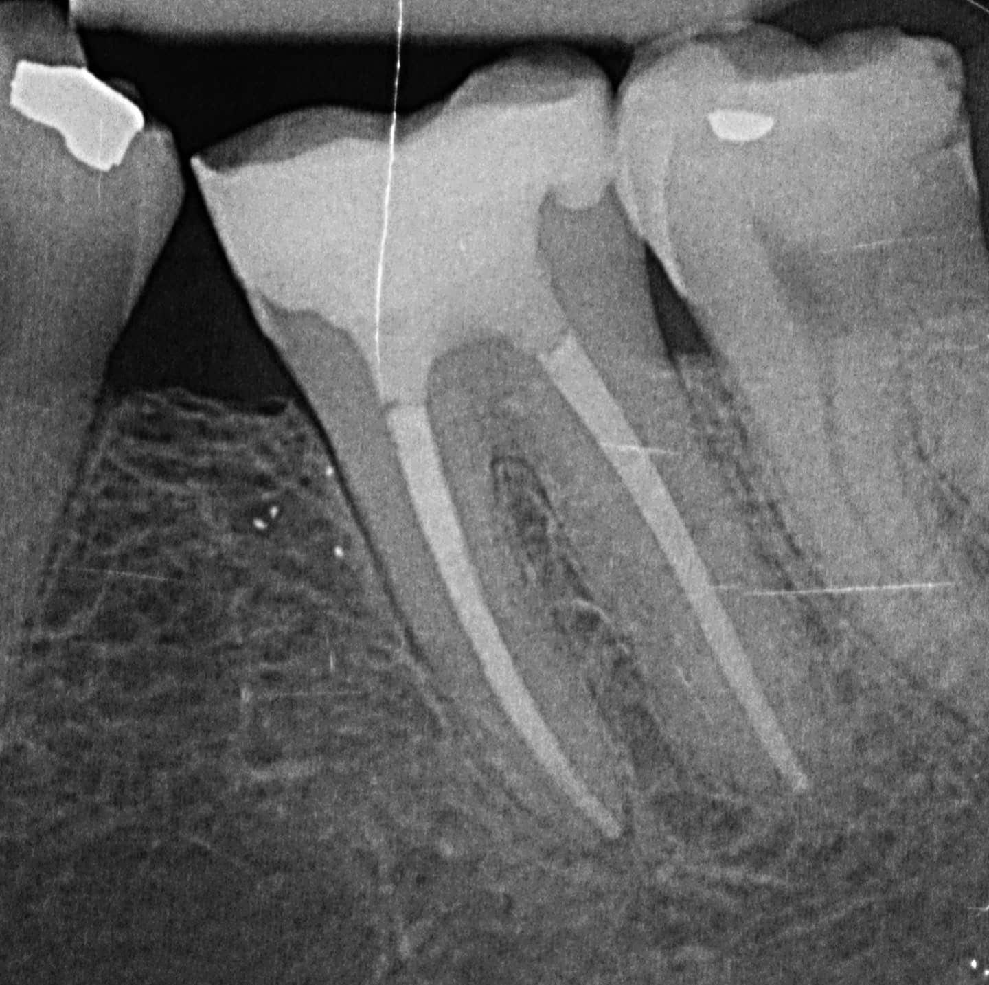Wurzerkanalbehandlung-röntgen
